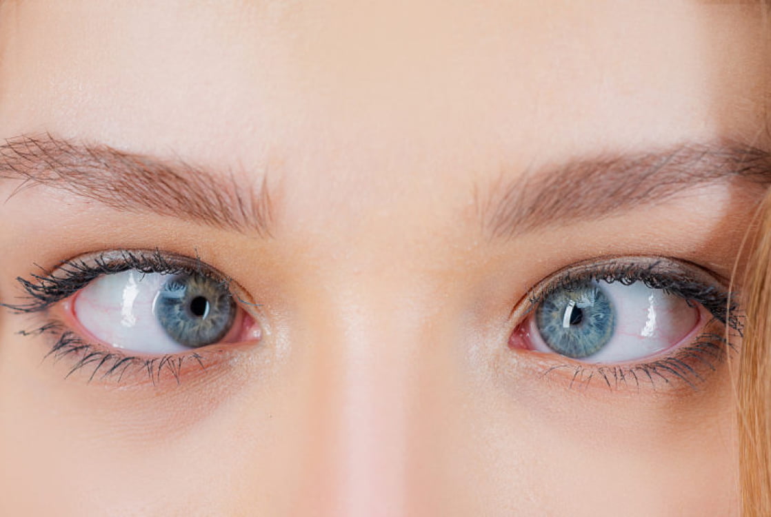 Strabismus (Crosses Eyes) — All You Need To Know